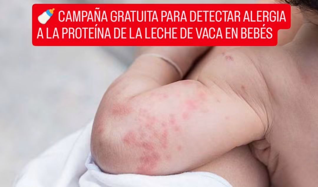  CAMPAÑA GRATUITA PARA DETECTAR ALERGIA A LA PROTEÍNA DE LA LECHE DE VACA EN BEBÉS